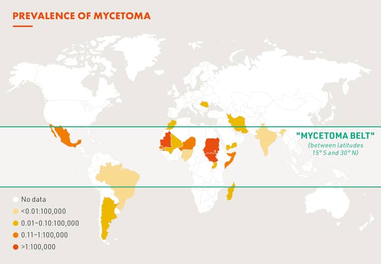 Global burden of mycetoma